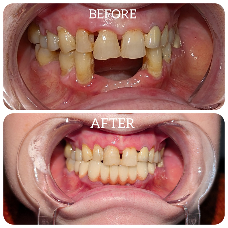 dental implants before after