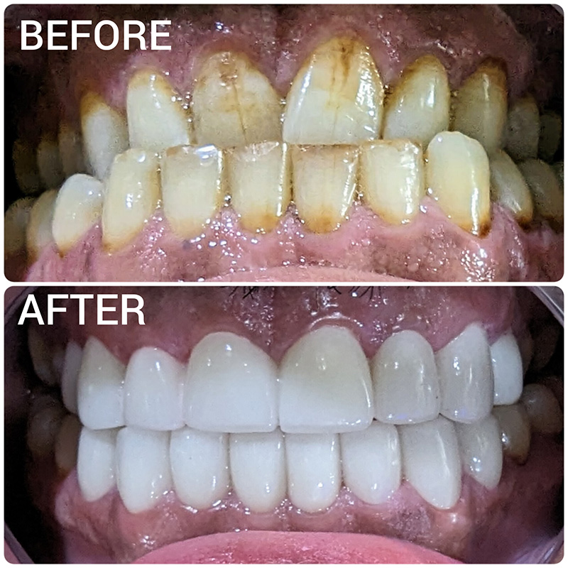 instant teeth whitening before and after