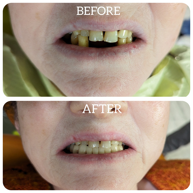 same day dental implants before after treatment
