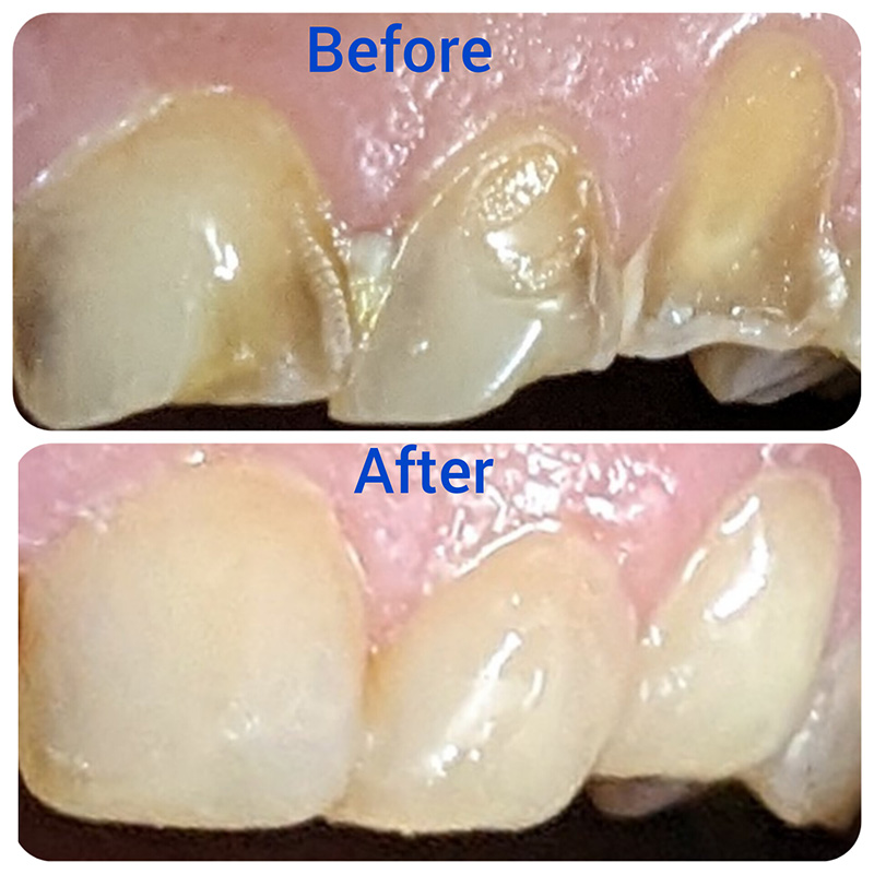 teeth cleaning polishing before after