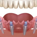 All-on-4-dental-implants-gugaon