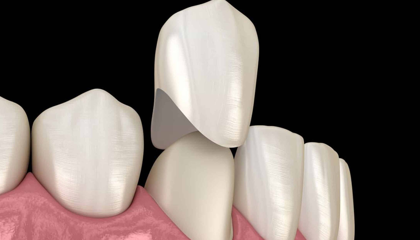 Dental-Crowns-treatment-in-gurgaon