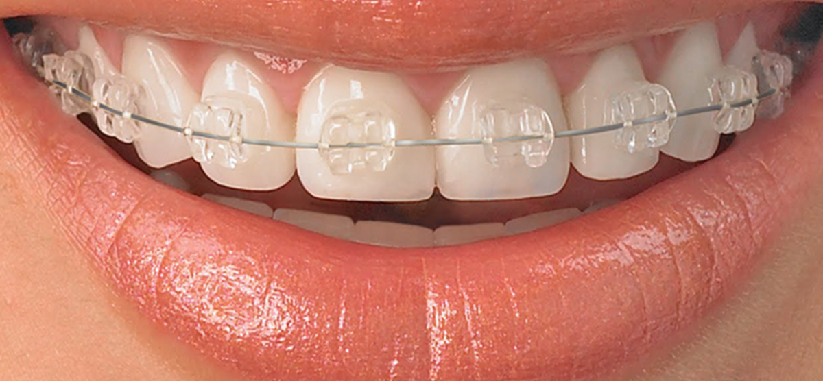 Self-Ligating Braces