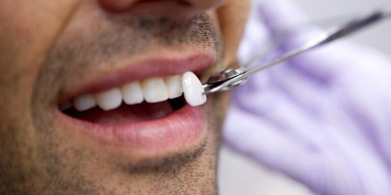 porcelain veneers in gurgaon