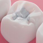 Composite Filling cost in Gurgaon