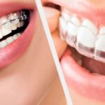 Clear Aligners vs. Braces