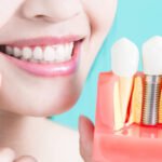 Missing Teeth - How Dental Implants Restore a Beautiful Smile