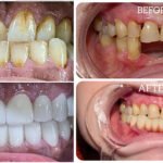 smile makeover cost in gurgaon