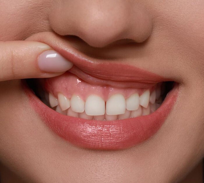Gum Health Is the New Smile Trend