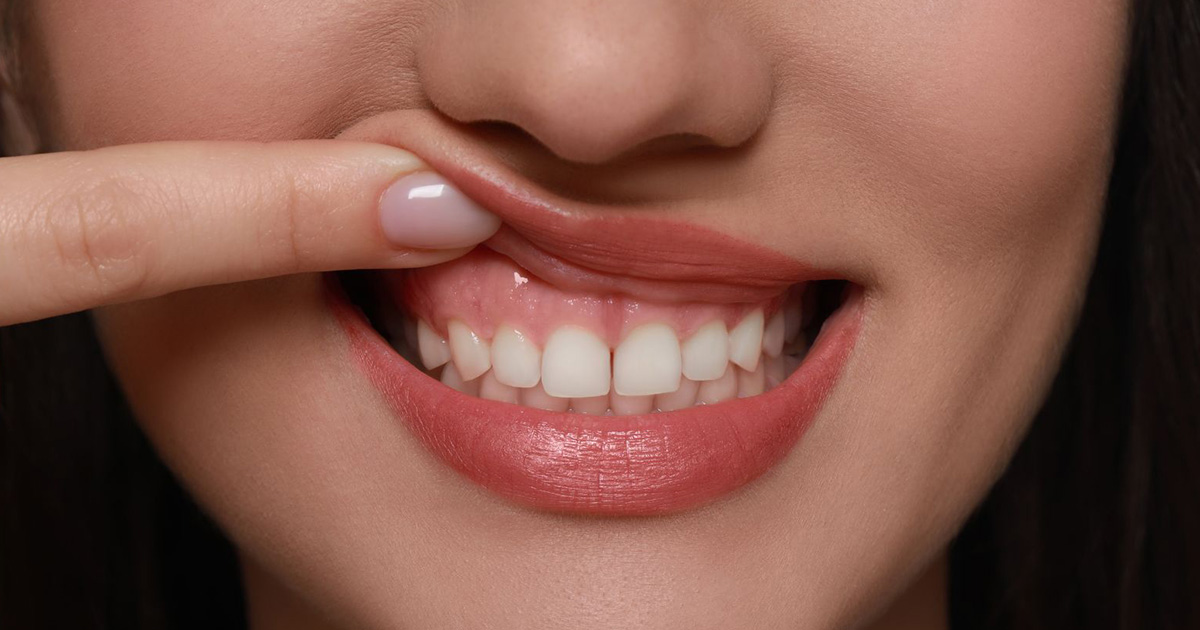 Gum Health Is the New Smile Trend