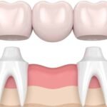 dental Bridges treatment in gurgaon
