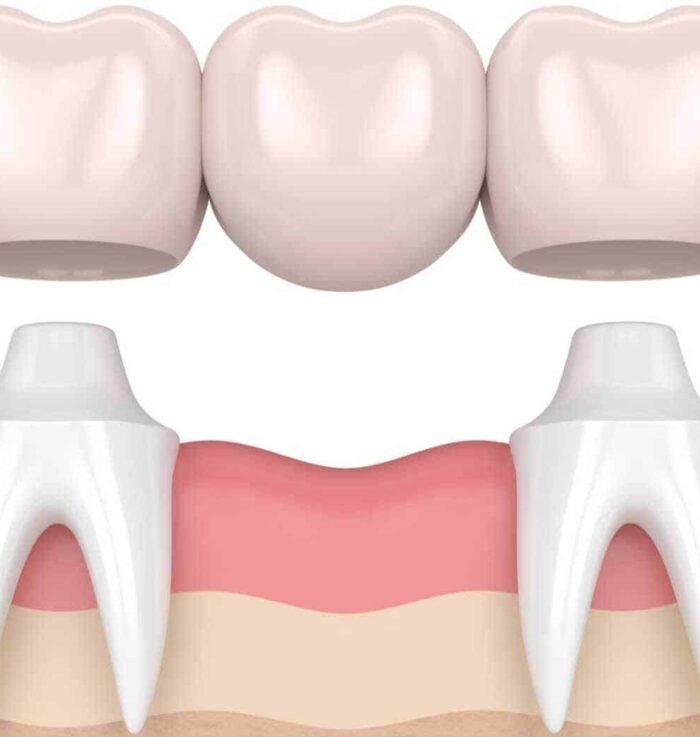 dental Bridges treatment in gurgaon