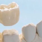 dental crowns in gurgaon
