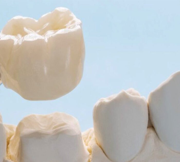 dental crowns in gurgaon