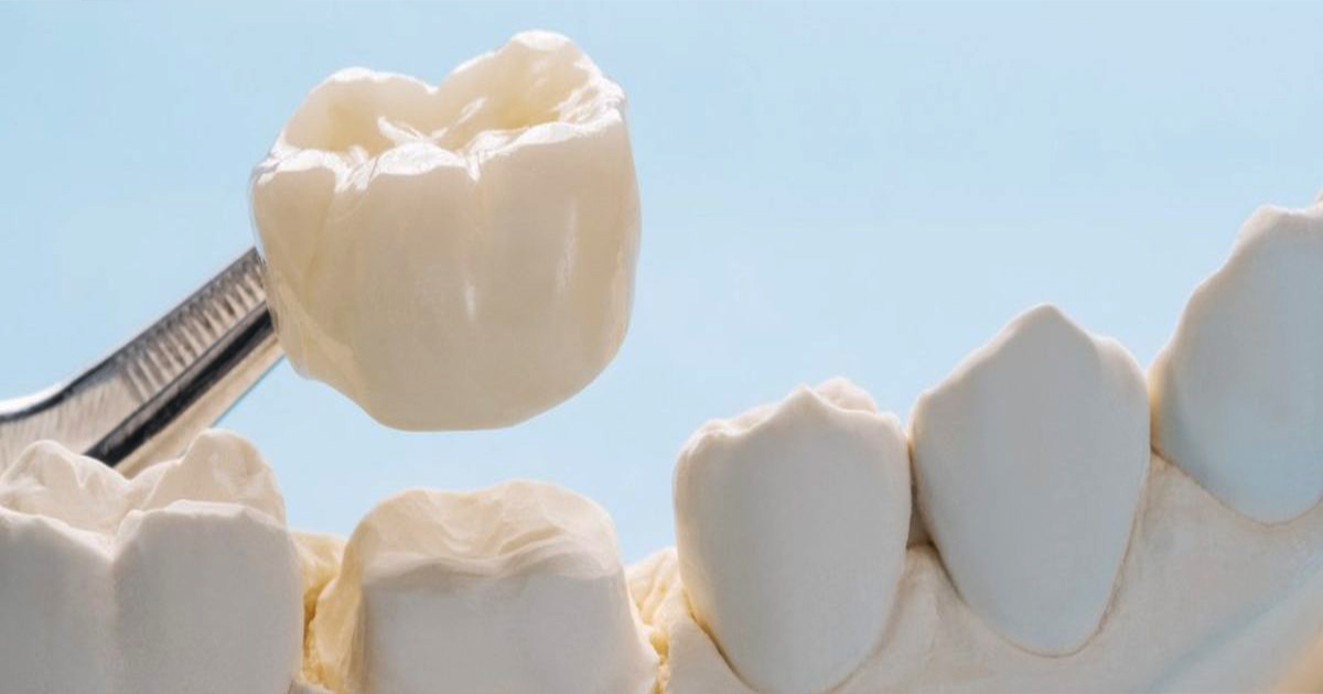dental crowns in gurgaon