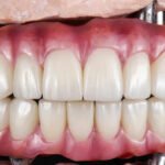 full-mouth-dental-implants in gurgaon