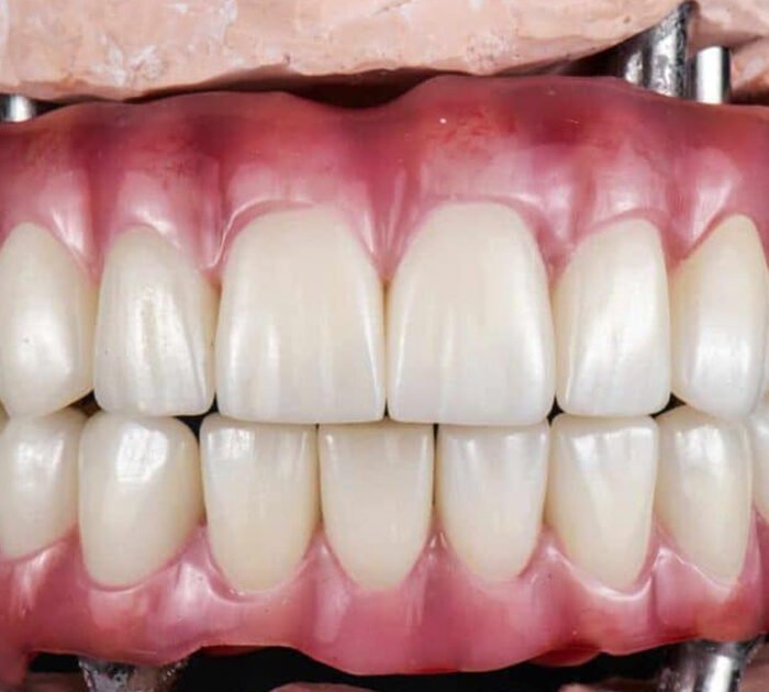 full-mouth-dental-implants in gurgaon