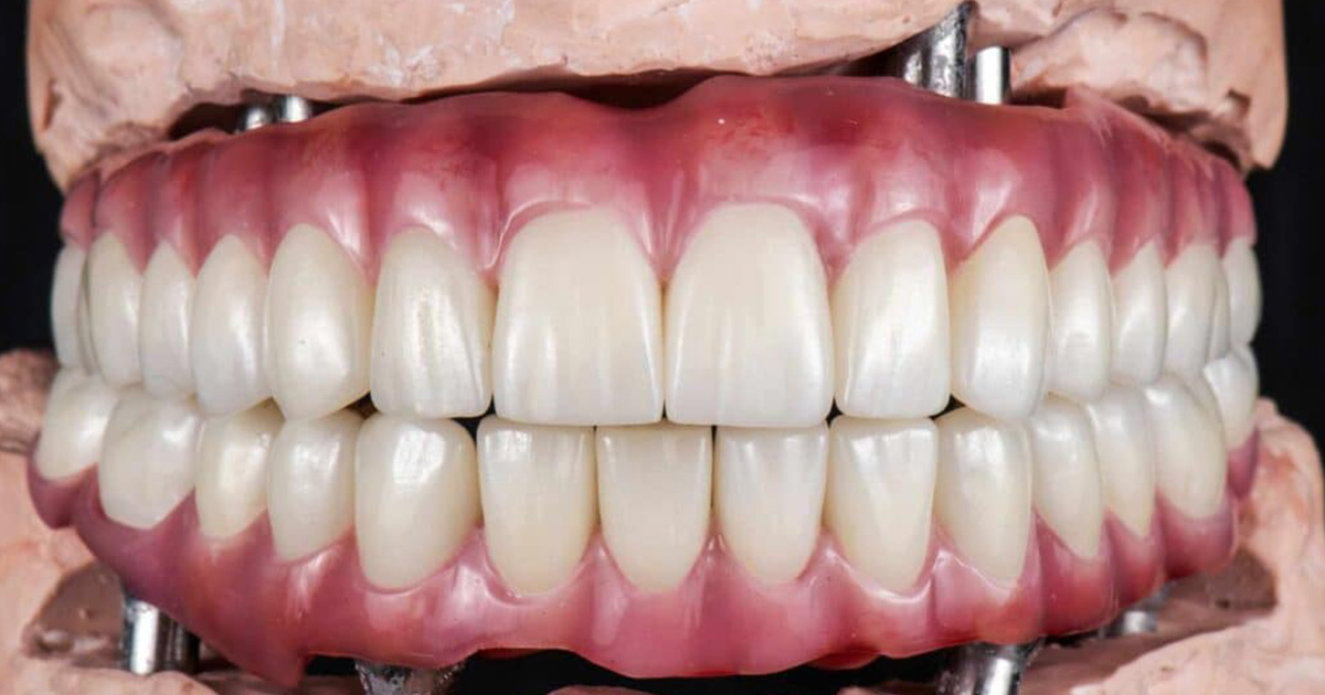 full-mouth-dental-implants in gurgaon