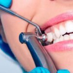 teeth-cleaning-in gurgaon