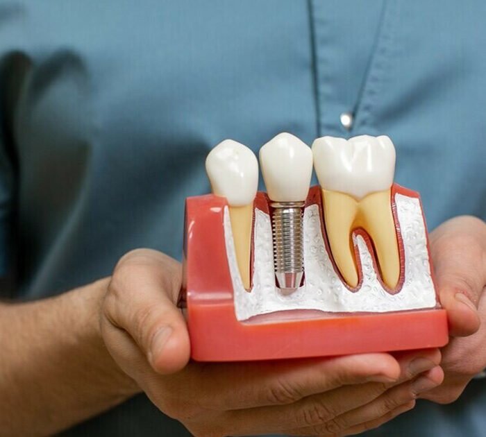 Best Implant Specialist in gurgaon