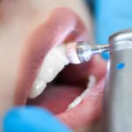 Fluoride Treatment in gurgaon