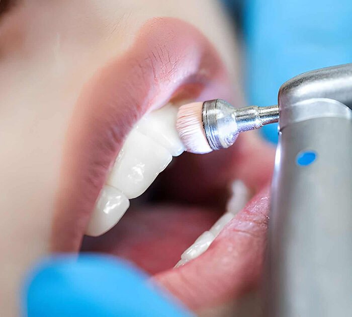 Fluoride Treatment in gurgaon