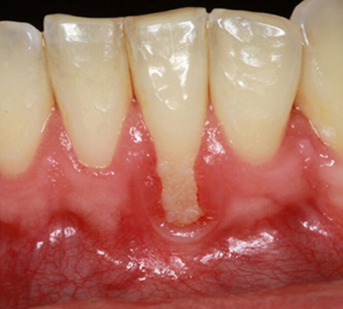 Gum Recession treatment in gurgaon