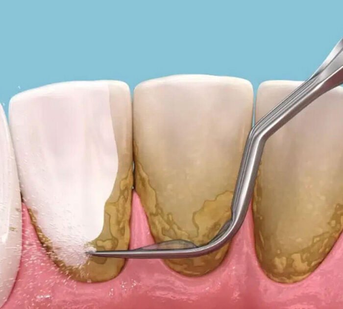 Laser Deep Cleaning Teeth in gurgaon
