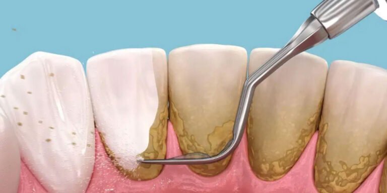 Laser Deep Cleaning Teeth in gurgaon