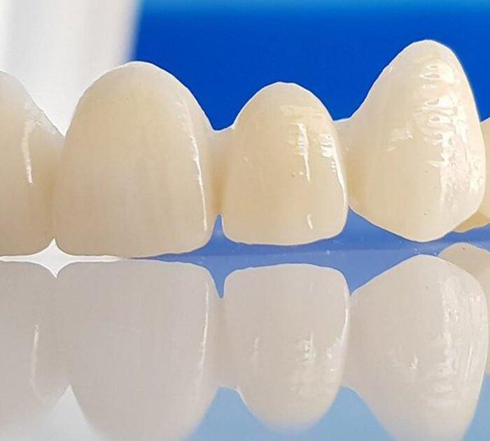 Dental Crowns in gurgaon