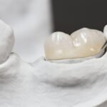 Inlays-and-Onlays in gurgaon with cost