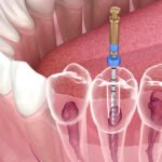 Root Canal Treatment in gurgaon