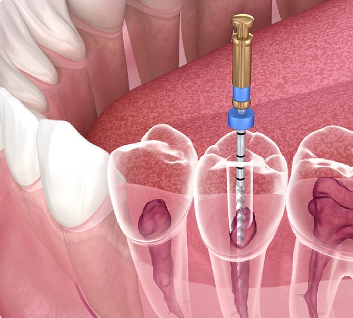 Root Canal Treatment in gurgaon