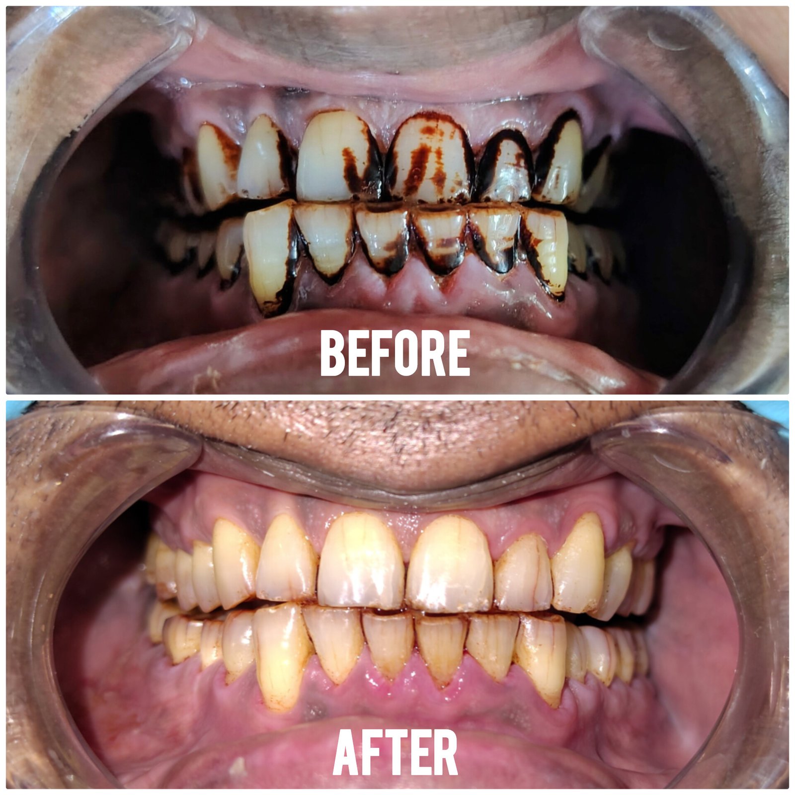 before after dental treatment 3
