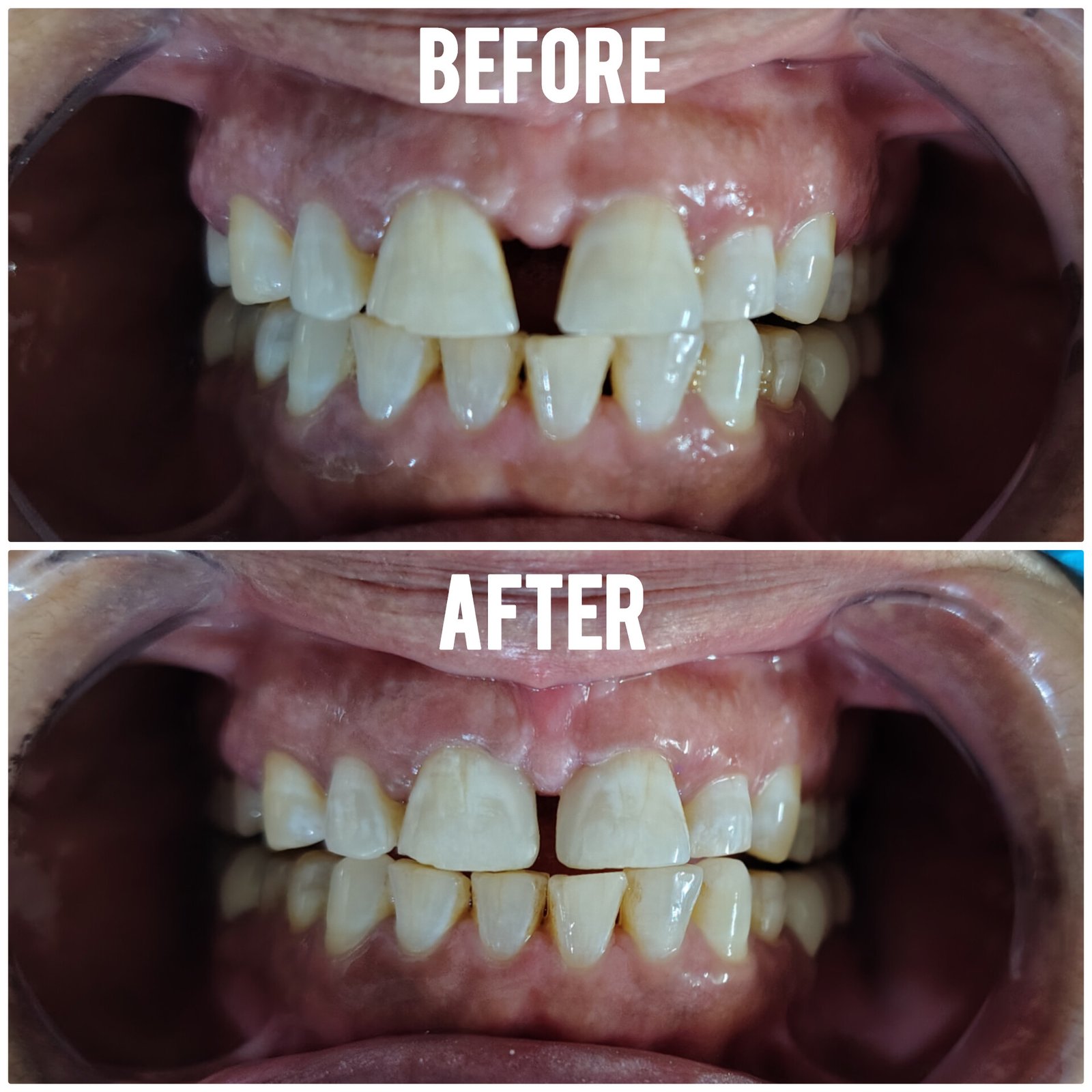before after dental treatment in gurgaon