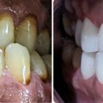 teeth whitening cost