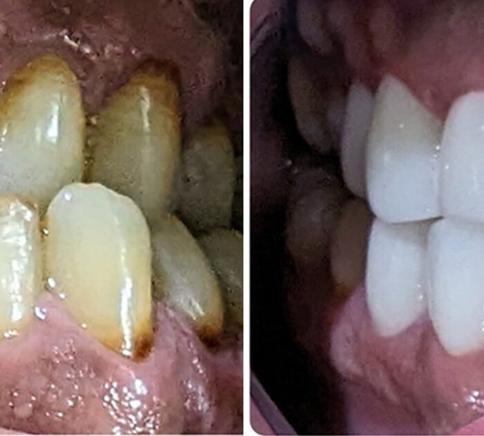 teeth whitening cost