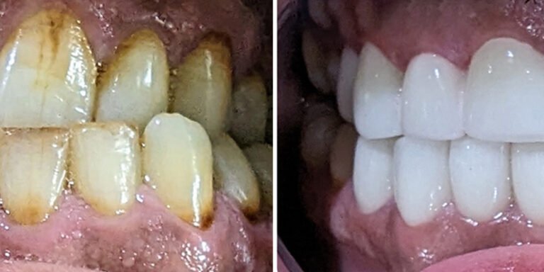 teeth whitening cost