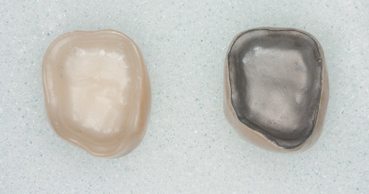 Zirconia Crowns vs PFM Crowns
