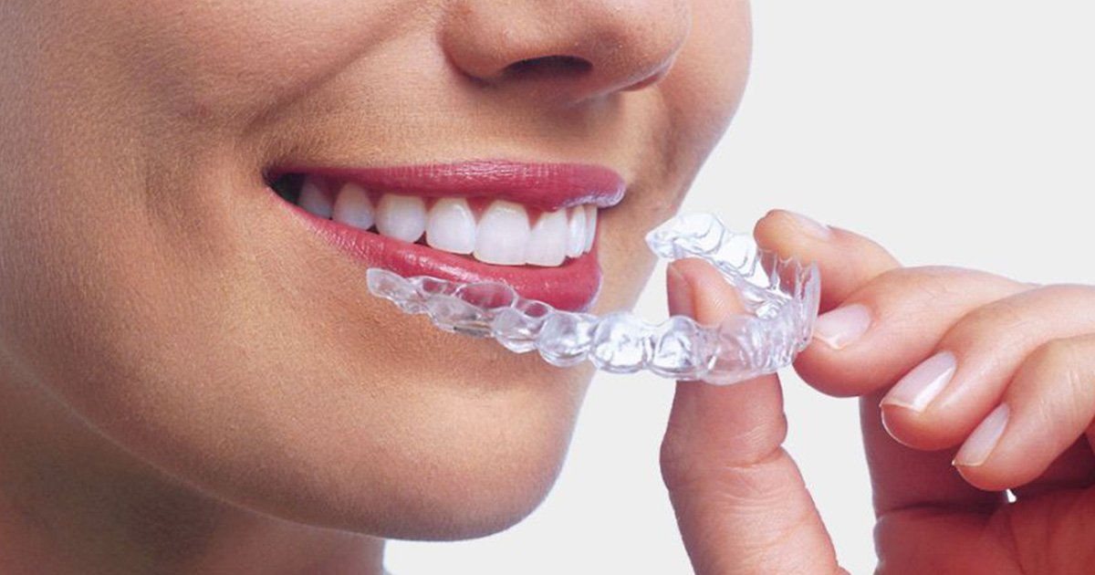 invisible braces in gurgaon