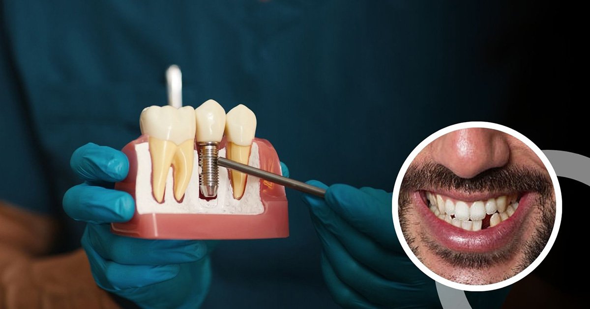 single tooth implants cost in sec 46 gurgaon